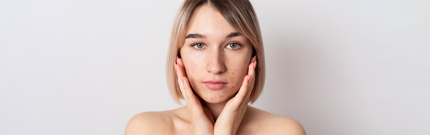 Cilt Lekesi Türleri Nelerdir?