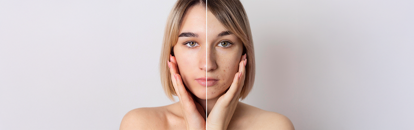 Ciltte Akne Neden Oluşur?