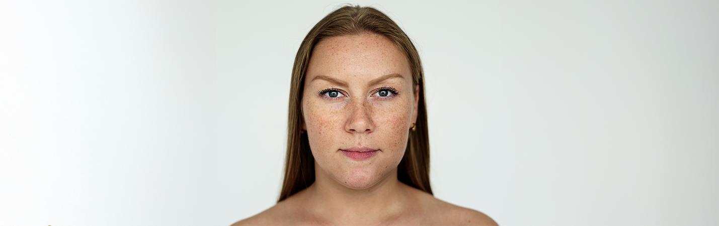 Ciltteki Kahverengi Lekeler Nasıl Geçer?