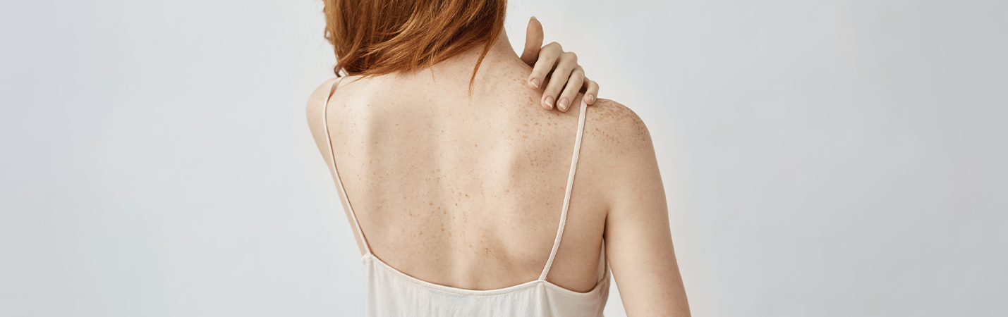 Vücutta Çıkan Sivilceler Nasıl Geçer?